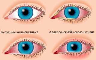 Какие капли помогут вылечить конъюнктивит быстро и эффективно