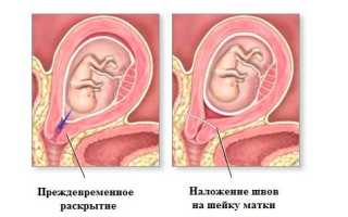 Чем опасна истмико-цервикальная недостаточность при беременности для здоровья?
