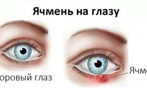 Эффективные средства для борьбы с ячменем на глазах
