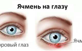 Эффективные средства для борьбы с ячменем на глазах
