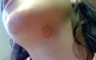 Лишай при беременности: причины и лечение