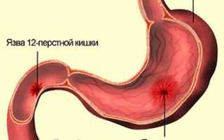 Диарея, рвота и температура