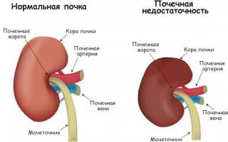 Что означает диагноз почечная недостаточность при беременности и его последствия