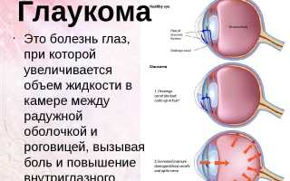 Глаукома: методы лечения и меры профилактики для здоровья глаз