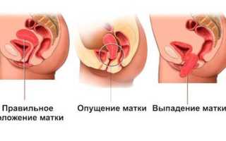 Опущение матки: симптомы и лечение, народные средства и медицина, массаж, видео