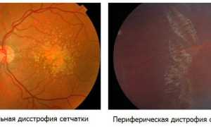 Симптомы дистрофии сетчатки глаза – след улитки и их последствия