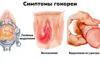 Гонорея при беременности: что за болезнь, чем опасна, как лечить и предотвратить