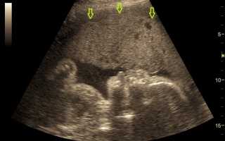 Гиперплазия плаценты: причины и последствия