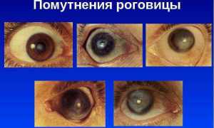 Что такое помутнение роговицы? Узнайте причины и симптомы