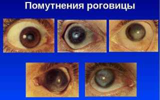 Что такое помутнение роговицы? Узнайте причины и симптомы