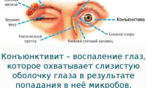 Симптомы и методы лечения конъюнктивита у взрослых и детей
