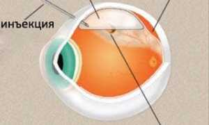 Симптомы отслоения сетчатки глаза и признаки, причины отслойки, важные рекомендации