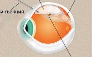 Симптомы отслоения сетчатки глаза и признаки, причины отслойки, важные рекомендации