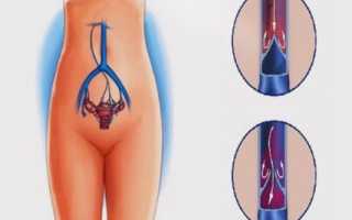 Роды при варикозе малого таза: особенности и рекомендации