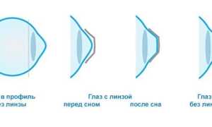 Ночные линзы – специфика ношения и возможные сложности для пользователей