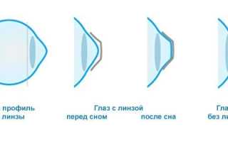 Ночные линзы – специфика ношения и возможные сложности для пользователей