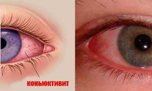 Как бороться с конъюнктивитом у взрослых? Полезные советы и рекомендации