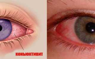 Как бороться с конъюнктивитом у взрослых? Полезные советы и рекомендации
