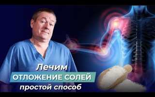 Отложение солей в суставах: лечение, эффективные рецепты, видео