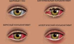 Почему гноятся глаза у взрослого – чем лечить и промыть в домашних условиях