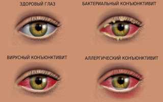 Почему гноятся глаза у взрослого – чем лечить и промыть в домашних условиях