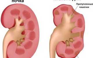 Опасен ли пиелонефрит при беременности для здоровья матери и ребенка