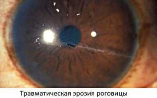 Эрозия роговицы глаза: чем опасно заболевание и как его предотвратить?