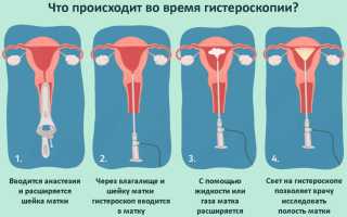 Гистерография при беременности: что это, в каких случаях необходима и как проводится