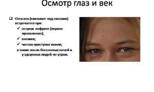 Отёкшие веки: причины и методы лечения для здоровья глаз