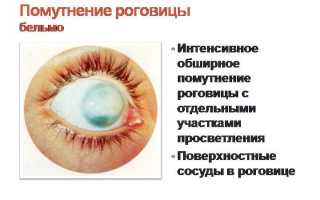 Особенности лечения бельма на глазу: важные аспекты и рекомендации