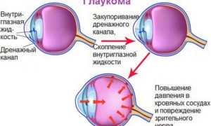 Глаукома: причины, симптомы, диагностика, операция и осложнения заболевания глаз