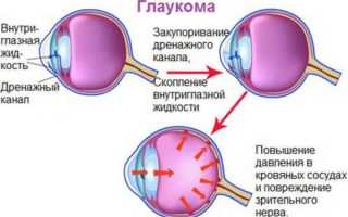 Глаукома: причины, симптомы, диагностика, операция и осложнения заболевания глаз