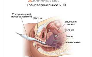Трансвагинальное УЗИ малого таза при варикозе во время беременности: важные аспекты и рекомендации