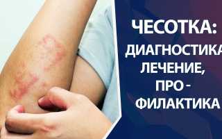 7 видов чесотки: как различить, симптомы и способы лечения, видео