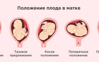Головное предлежание плода: особенности и последствия