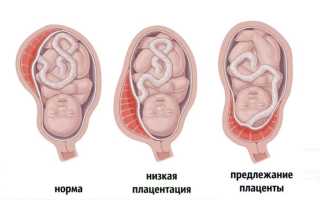 Чем грозит для плода низкое предлежание плаценты при беременности: важные аспекты
