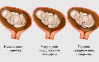 Краевое предлежание плаценты: причины и последствия