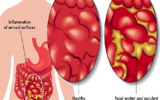 Острые перитониты: прогрессирующий и разлитой, течение болезни
