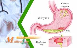 Прободная язва желудка: основные причины, симптомы и методы лечения, видео