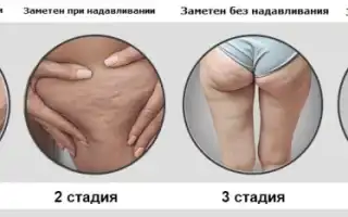 Целлюлит при беременности: причины и способы борьбы