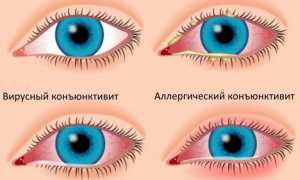Капли для глаз от конъюнктивита: эффективные решения для здоровья