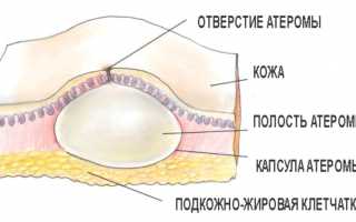 Лечение атеромы молочной железы: способы и средства, симптомы