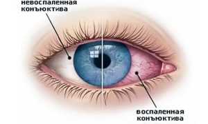Что делать, если у ребенка гноятся глаза: советы и рекомендации