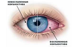 Что делать, если у ребенка гноятся глаза: советы и рекомендации