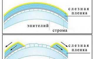 Сухой глаз: симптомы, лечение синдрома ССГ и рекомендации