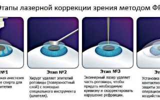 Операция на глаза – как делают лазером и как проходит лазерная коррекция зрения