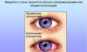 Лечение и профилактика конъюнктивита. Детские глазные капли для здоровья глаз