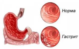 Хронический и острый гастрит у взрослых: лечение и диета, видео