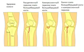 Опухло колено без ушиба? Причины возникновения опухолей, видео рецепты лечения