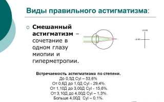 Смешанный астигматизм: причины развития и варианты лечения глазных заболеваний
